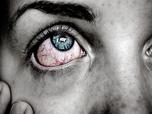 Auge_Cluster Kopfschmerz_Praxis_Hansel-Ziegler